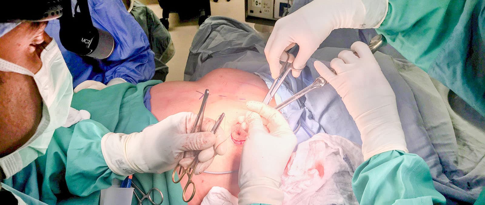 Die Zukunft der Brustchirurgie: Brustvergrößerung mit Eigenfett in Bochum